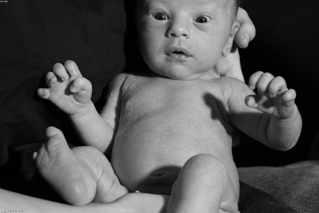 기저귀 발진 유형별 증상 비교